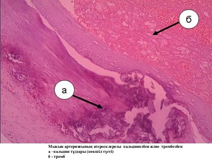 Мықын артериясының атеросклерозы кальцинозбен және тромбозбен а –кальции тұздары (көкшіл түсті) б - тромб