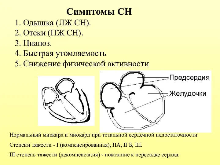 Симптомы СН 1. Одышка (ЛЖ СН). 2. Отеки (ПЖ СН). 3.