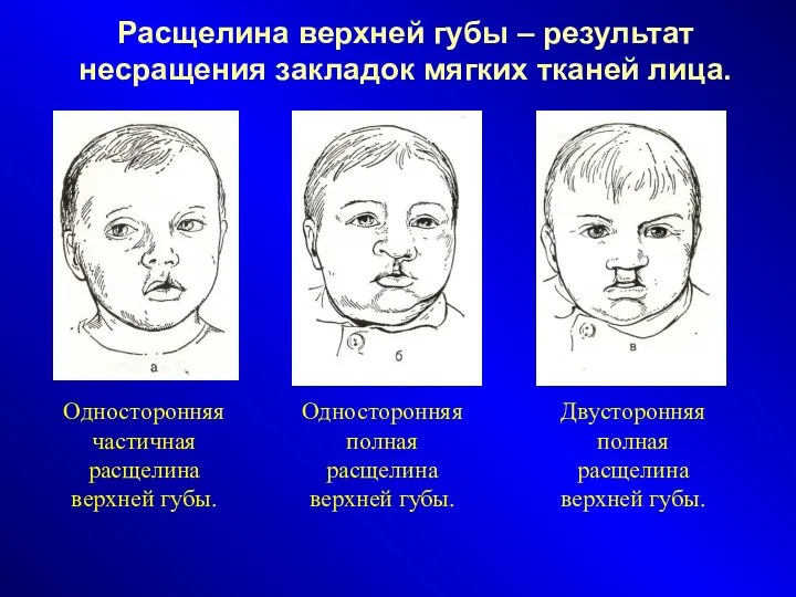 Расщелина верхней губы – результат несращения закладок мягких тканей лица. Односторонняя