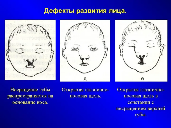 Дефекты развития лица. Несращение губы распространяется на основание носа. Открытая глазнично-носовая