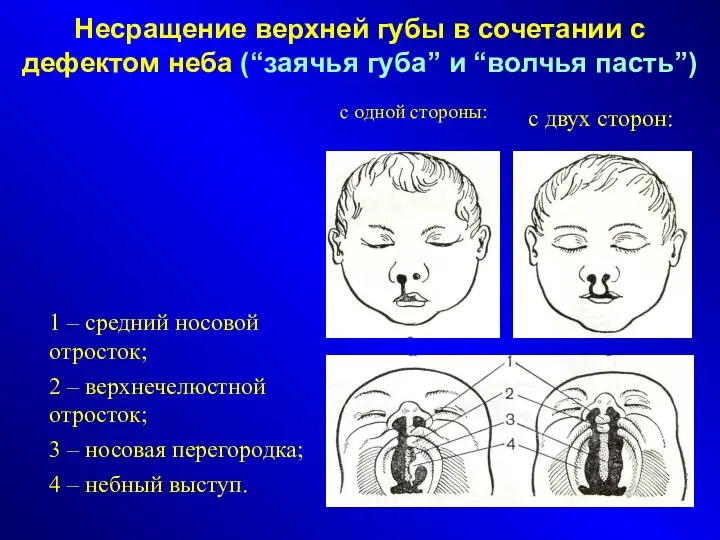 Несращение верхней губы в сочетании с дефектом неба (“заячья губа” и