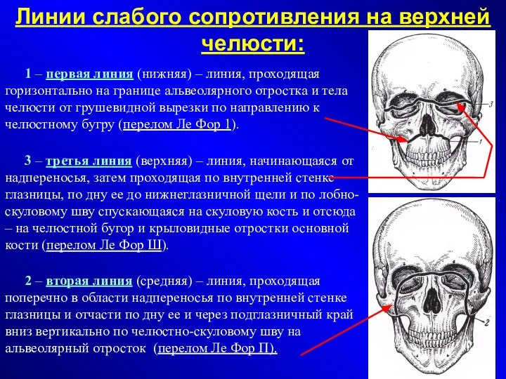 Линии слабого сопротивления на верхней челюсти: 1 – первая линия (нижняя)