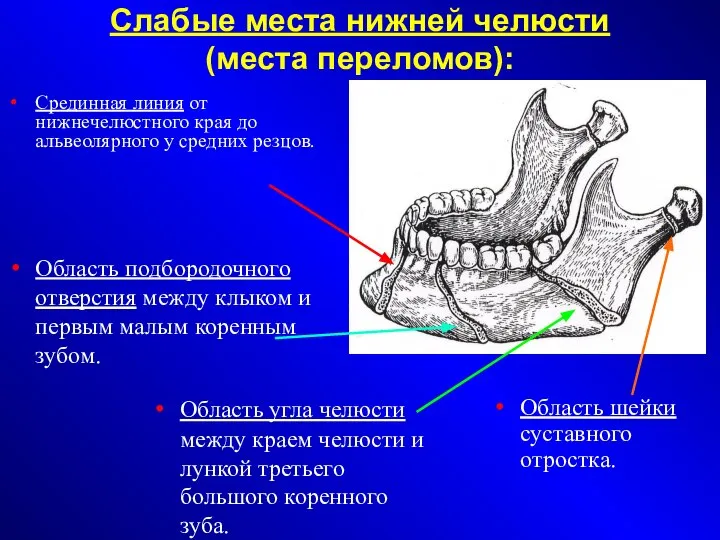 Слабые места нижней челюсти (места переломов)‏: Срединная линия от нижнечелюстного края