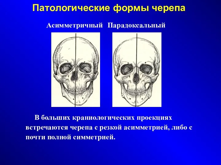 Патологические формы черепа Асимметричный Парадоксальный В больших краниологических проекциях встречаются черепа