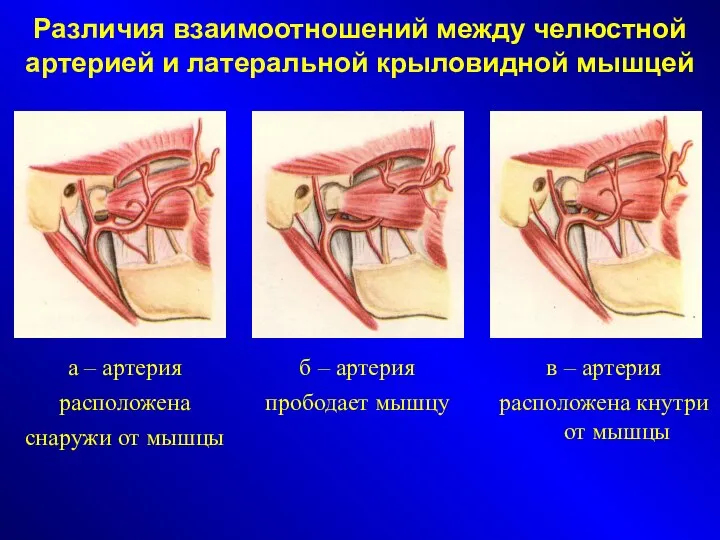 Различия взаимоотношений между челюстной артерией и латеральной крыловидной мышцей а –