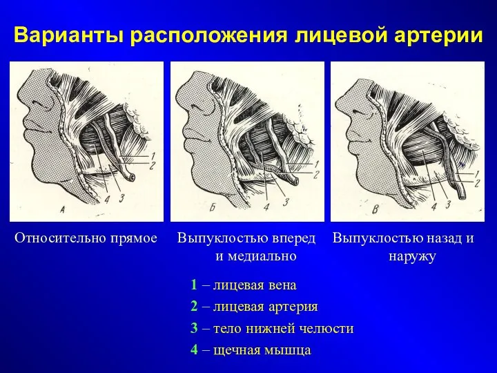 Варианты расположения лицевой артерии Относительно прямое Выпуклостью вперед и медиально Выпуклостью