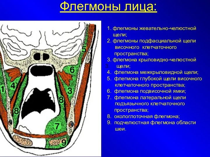 Флегмоны лица: 1. флегмоны жевательно-челюстной щели; 2. флегмоны подфасциальной щели височного