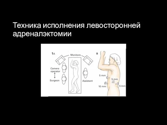 Техника исполнения левосторонней адреналэктомии