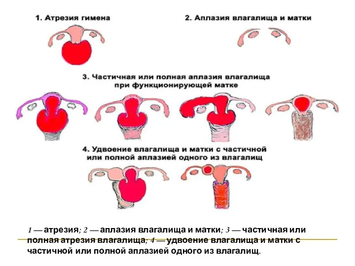 1 — атрезия; 2 — аплазия влагалища и матки; 3 —