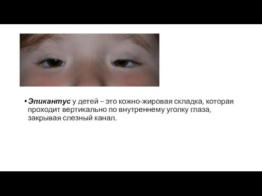 Эпикантус у детей – это кожно-жировая складка, которая проходит вертикально по