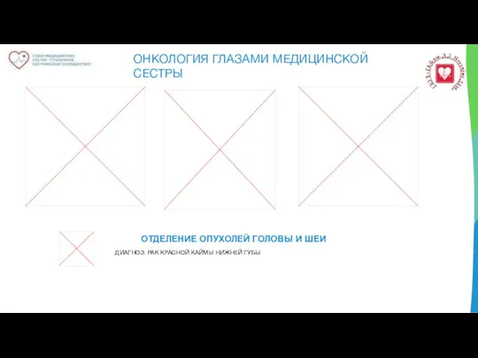 ОНКОЛОГИЯ ГЛАЗАМИ МЕДИЦИНСКОЙ СЕСТРЫ ОТДЕЛЕНИЕ ОПУХОЛЕЙ ГОЛОВЫ И ШЕИ ДИАГНОЗ: РАК КРАСНОЙ КАЙМЫ НИЖНЕЙ ГУБЫ