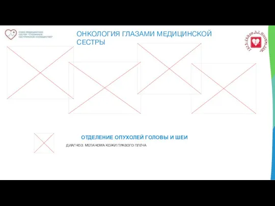 ОНКОЛОГИЯ ГЛАЗАМИ МЕДИЦИНСКОЙ СЕСТРЫ ОТДЕЛЕНИЕ ОПУХОЛЕЙ ГОЛОВЫ И ШЕИ ДИАГНОЗ: МЕЛАНОМА КОЖИ ПРАВОГО ПЛЕЧА