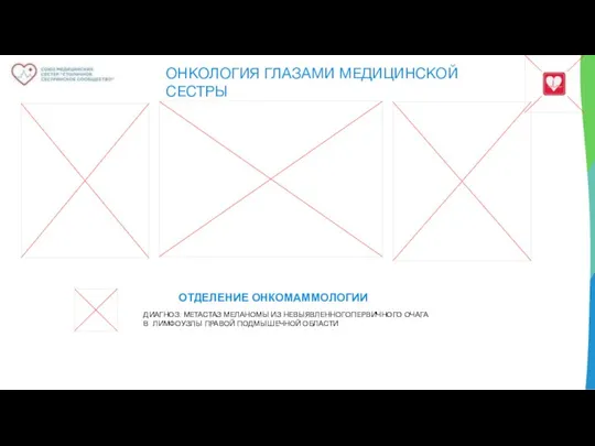 ОНКОЛОГИЯ ГЛАЗАМИ МЕДИЦИНСКОЙ СЕСТРЫ ОТДЕЛЕНИЕ ОНКОМАММОЛОГИИ ДИАГНОЗ: МЕТАСТАЗ МЕЛАНОМЫ ИЗ НЕВЫЯВЛЕННОГОПЕРВИЧНОГО