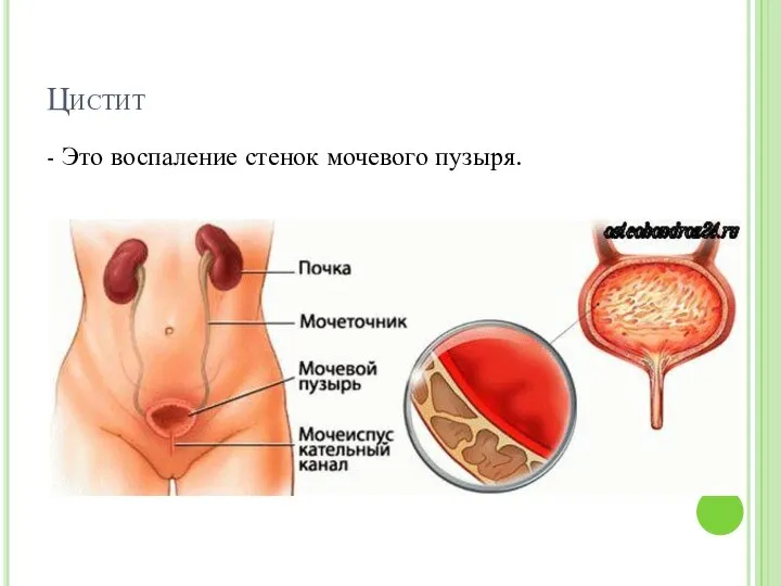 Цистит - Это воспаление стенок мочевого пузыря.