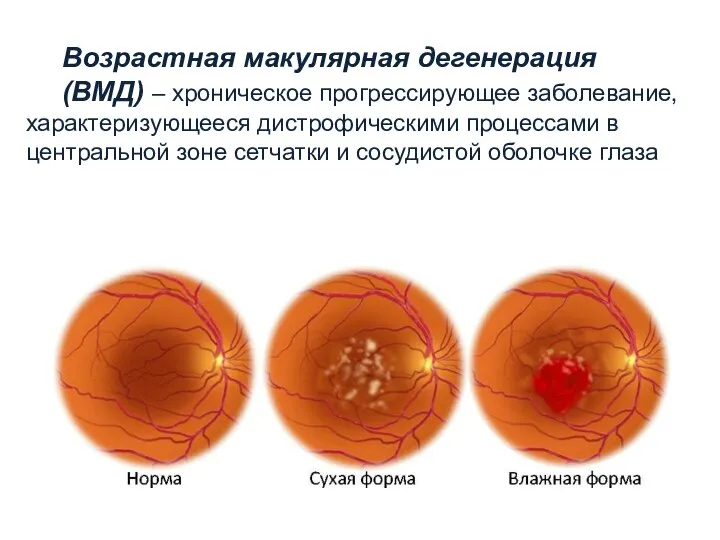 Возрастная макулярная дегенерация (ВМД) – хроническое прогрессирующее заболевание, характеризующееся дистрофическими процессами