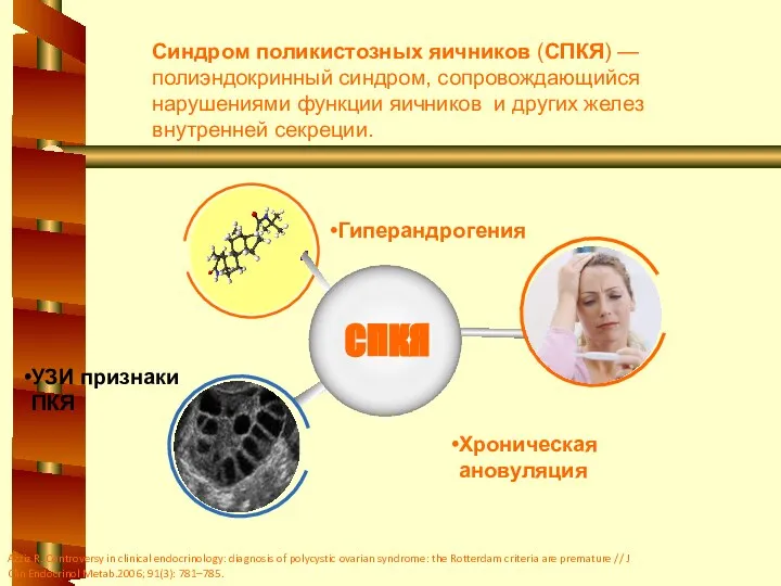 Гиперандрогения Хроническая ановуляция УЗИ признаки ПКЯ СПКЯ Синдром поликистозных яичников (СПКЯ)