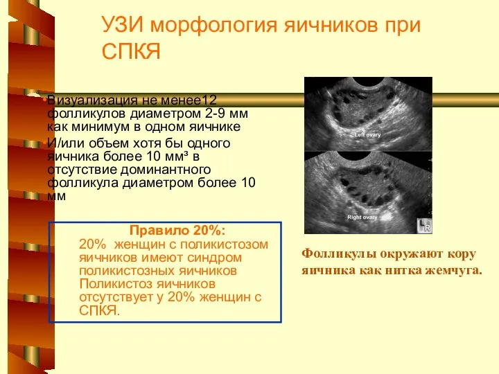 УЗИ морфология яичников при СПКЯ Фолликулы окружают кору яичника как нитка