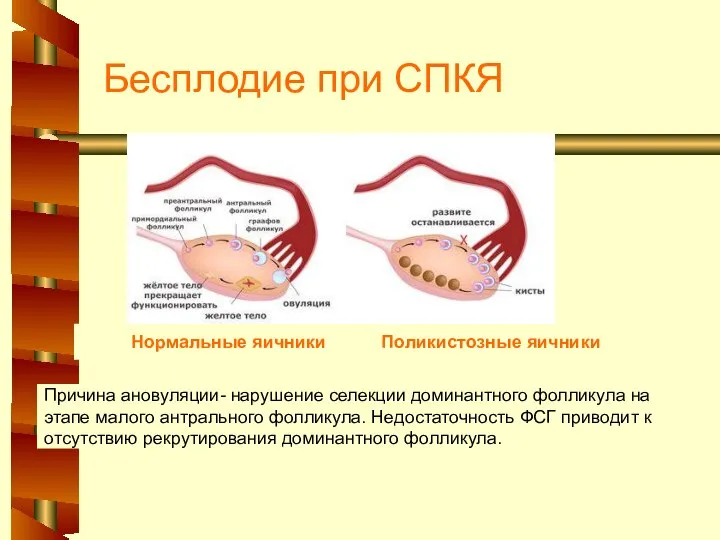 Бесплодие при СПКЯ Нормальные яичники Поликистозные яичники Причина ановуляции- нарушение селекции