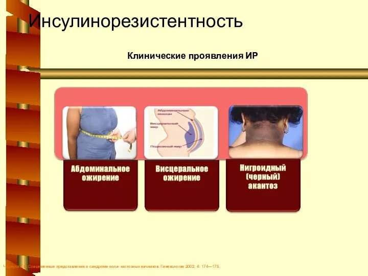 Инсулинорезистентность Чернуха Г.Е. Современные представления о синдроме поли- кистозных яичников. Гинекология