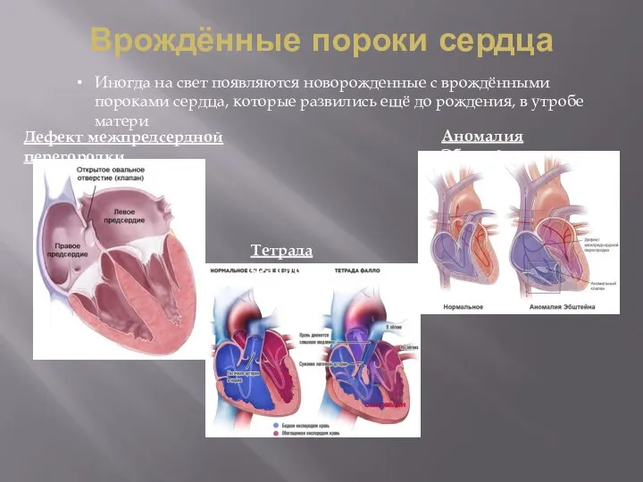 Врождённые пороки сердца Иногда на свет появляются новорожденные с врождёнными пороками