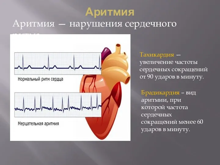 Аритмия Аритмия — нарушения сердечного ритма Тахикардия — увеличение частоты сердечных