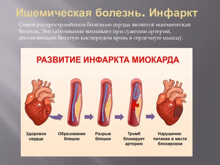 Ишемическая болезнь. Инфаркт Самой распространённой болезнью сердца является ишемическая болезнь. Это