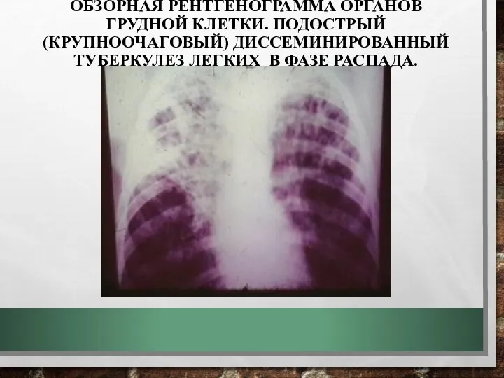 ОБЗОРНАЯ РЕНТГЕНОГРАММА ОРГАНОВ ГРУДНОЙ КЛЕТКИ. ПОДОСТРЫЙ (КРУПНООЧАГОВЫЙ) ДИССЕМИНИРОВАННЫЙ ТУБЕРКУЛЕЗ ЛЕГКИХ В ФАЗЕ РАСПАДА.