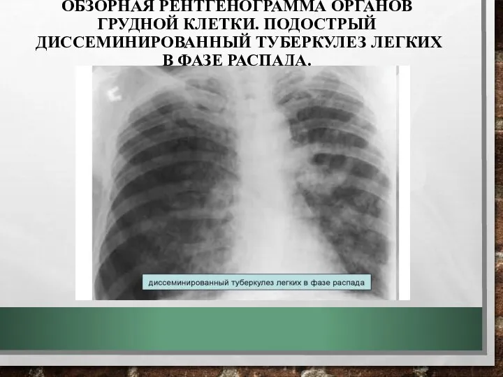 ОБЗОРНАЯ РЕНТГЕНОГРАММА ОРГАНОВ ГРУДНОЙ КЛЕТКИ. ПОДОСТРЫЙ ДИССЕМИНИРОВАННЫЙ ТУБЕРКУЛЕЗ ЛЕГКИХ В ФАЗЕ РАСПАДА.