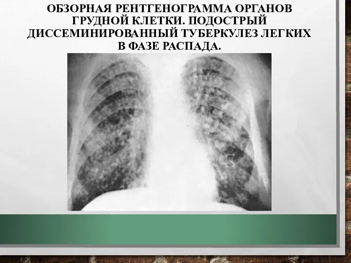 ОБЗОРНАЯ РЕНТГЕНОГРАММА ОРГАНОВ ГРУДНОЙ КЛЕТКИ. ПОДОСТРЫЙ ДИССЕМИНИРОВАННЫЙ ТУБЕРКУЛЕЗ ЛЕГКИХ В ФАЗЕ РАСПАДА.