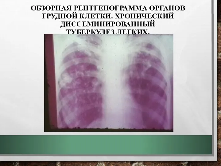 ОБЗОРНАЯ РЕНТГЕНОГРАММА ОРГАНОВ ГРУДНОЙ КЛЕТКИ. ХРОНИЧЕСКИЙ ДИССЕМИНИРОВАННЫЙ ТУБЕРКУЛЕЗ ЛЕГКИХ.