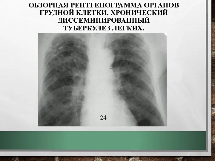 ОБЗОРНАЯ РЕНТГЕНОГРАММА ОРГАНОВ ГРУДНОЙ КЛЕТКИ. ХРОНИЧЕСКИЙ ДИССЕМИНИРОВАННЫЙ ТУБЕРКУЛЕЗ ЛЕГКИХ.