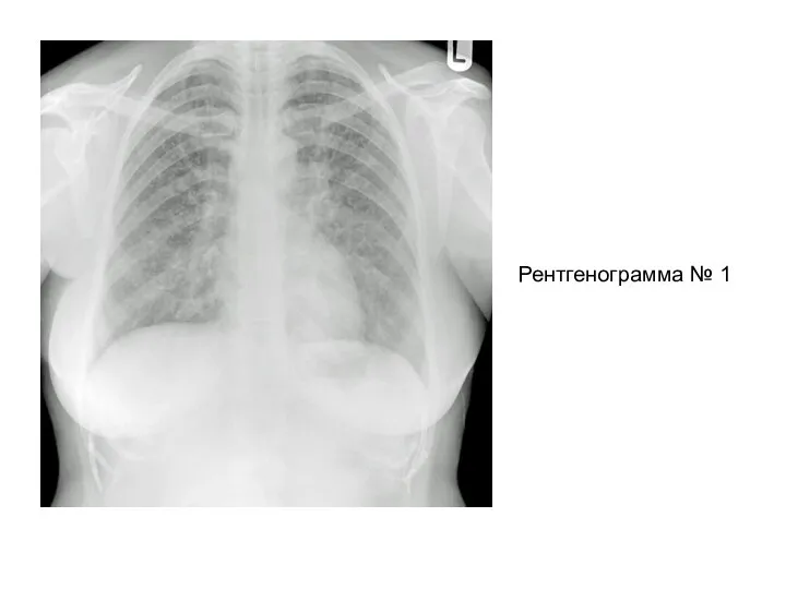Рентгенограмма № 1