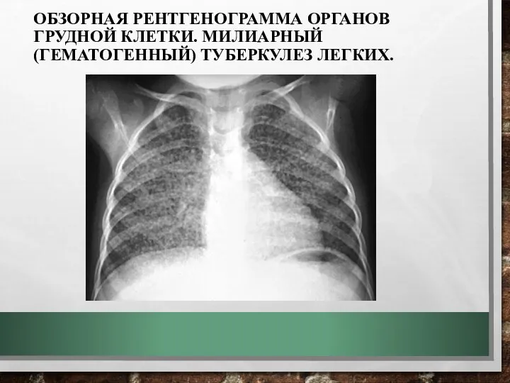 ОБЗОРНАЯ РЕНТГЕНОГРАММА ОРГАНОВ ГРУДНОЙ КЛЕТКИ. МИЛИАРНЫЙ (ГЕМАТОГЕННЫЙ) ТУБЕРКУЛЕЗ ЛЕГКИХ.