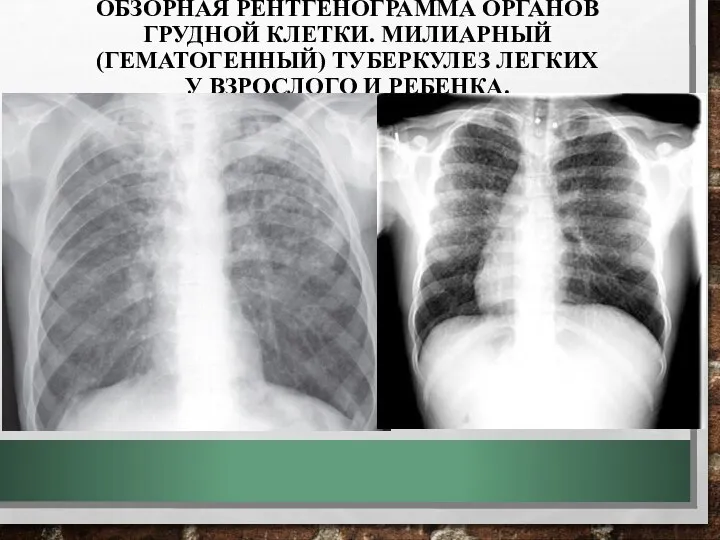 ОБЗОРНАЯ РЕНТГЕНОГРАММА ОРГАНОВ ГРУДНОЙ КЛЕТКИ. МИЛИАРНЫЙ (ГЕМАТОГЕННЫЙ) ТУБЕРКУЛЕЗ ЛЕГКИХ У ВЗРОСЛОГО И РЕБЕНКА.