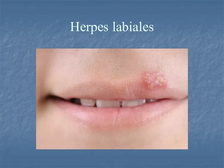 Herpes labiales