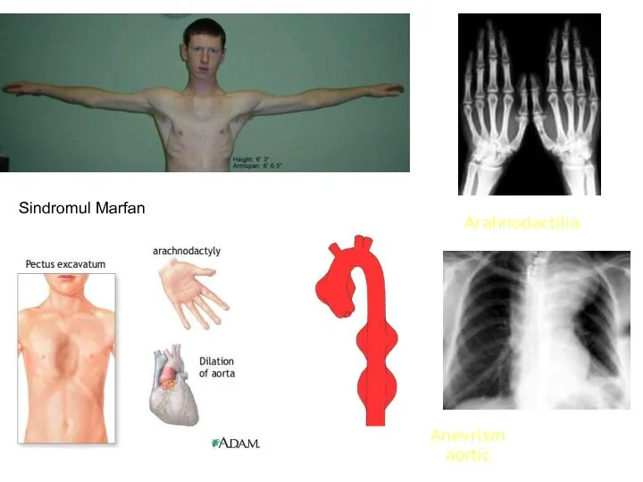 Sindromul Marfan