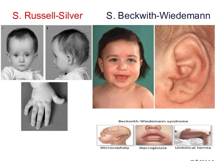 S. Russell-Silver S. Beckwith-Wiedemann