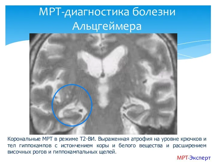 Корональные МРТ в режиме Т2-ВИ. Выраженная атрофия на уровне крючков и