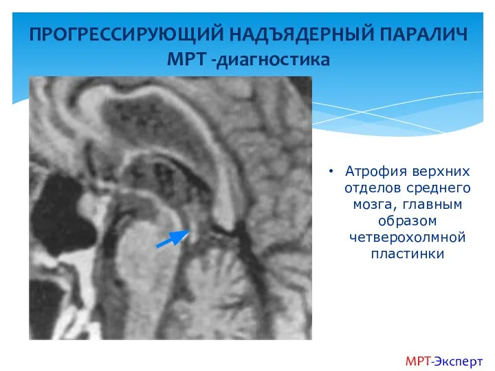 ПРОГРЕССИРУЮЩИЙ НАДЪЯДЕРНЫЙ ПАРАЛИЧ МРТ -диагностика МРТ-Эксперт Атрофия верхних отделов среднего мозга, главным образом четверохолмной пластинки