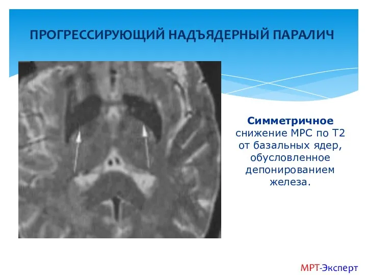 ПРОГРЕССИРУЮЩИЙ НАДЪЯДЕРНЫЙ ПАРАЛИЧ МРТ-Эксперт Симметричное снижение МРС по Т2 от базальных ядер, обусловленное депонированием железа.