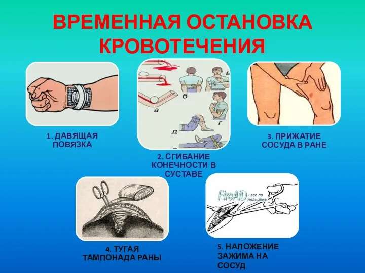 ВРЕМЕННАЯ ОСТАНОВКА КРОВОТЕЧЕНИЯ 5. НАЛОЖЕНИЕ ЗАЖИМА НА СОСУД