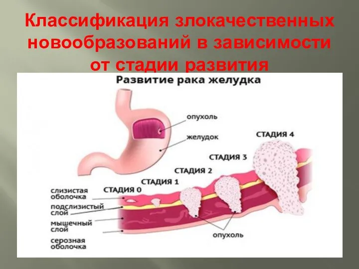 Классификация злокачественных новообразований в зависимости от стадии развития