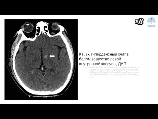 КТ, ax, гиперденсный очаг в белом веществе левой внутренней капсулы, ДАП https://www.uptodate.com/contents/traumatic-brain-injury-epidemiology-classification-and-pathophysiology?search=diffuse%20axonal%20injury%20diffusion%20tensor&source=search_result&selectedTitle=2~150&usage_type=default&display_rank=2