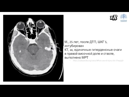 М., 25 лет, после ДТП, ШКГ 5, интубирован КТ, ax, единичные