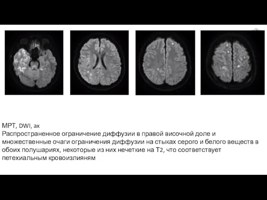 МРТ, DWI, ax Распространенное ограничение диффузии в правой височной доле и