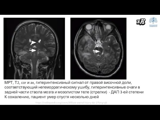 МРТ, Т2, cor и ax, гиперинтенсивный сигнал от правой височной доли,