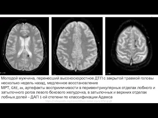 Молодой мужчина, перенесший высокоскоростное ДТП с закрытой травмой головы несколько недель