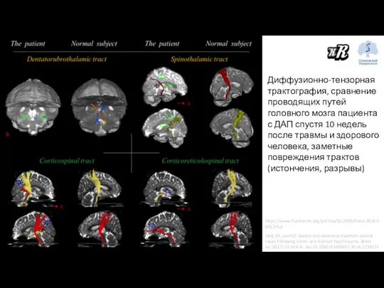 https://www.frontiersin.org/articles/10.3389/fneur.2018.00057/full Диффузионно-тензорная трактография, сравнение проводящих путей головного мозга пациента с ДАП