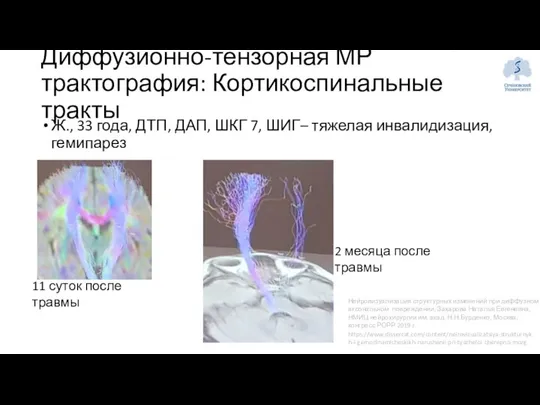 Ж., 33 года, ДТП, ДАП, ШКГ 7, ШИГ– тяжелая инвалидизация, гемипарез