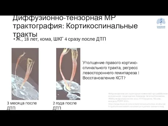 Ж., 18 лет, кома, ШКГ 4 сразу после ДТП Диффузионно-тензорная МР